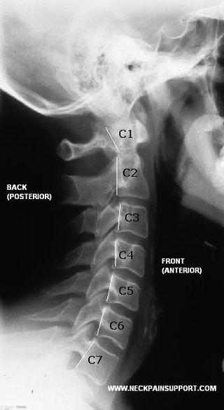 cspine